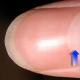 Меланома: когда пятнышко на ногте — симптом опасной болезни Отбитый ноготь на ноге или меланома