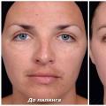 Prednosti i štete od pilinga lica: što postupak čini i koliko je siguran