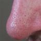 Kako se znebiti ogrcev na obrazu - preizkušena zdravila Odstranjevanje ogrcev na obrazu doma