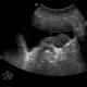 Amniotik bantlar: tashxis va oqibatlari Bachadon bo'shlig'idagi amniotik tasma nima