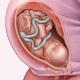Slabost tijekom trudnoće - zašto i kada?