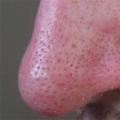 Kako se znebiti ogrcev na obrazu - preizkušena zdravila Odstranjevanje ogrcev na obrazu doma